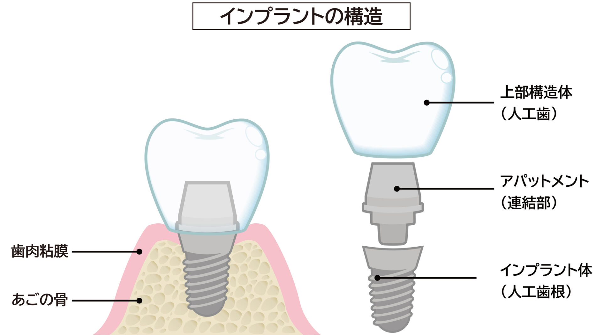 インプラントの構造